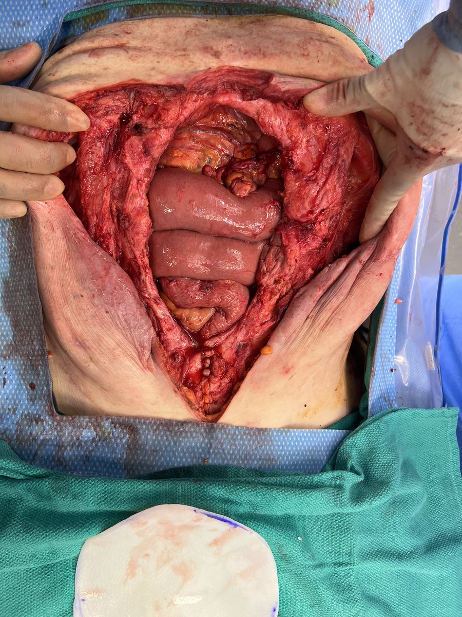 John Monson MD FRCS FACS FASCRS tweet media