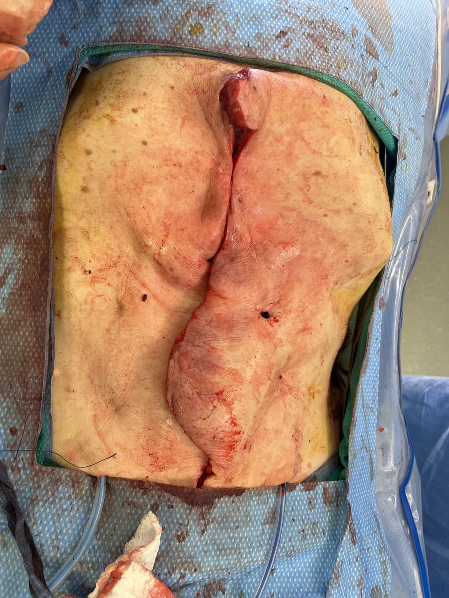 John Monson MD FRCS FACS FASCRS tweet media