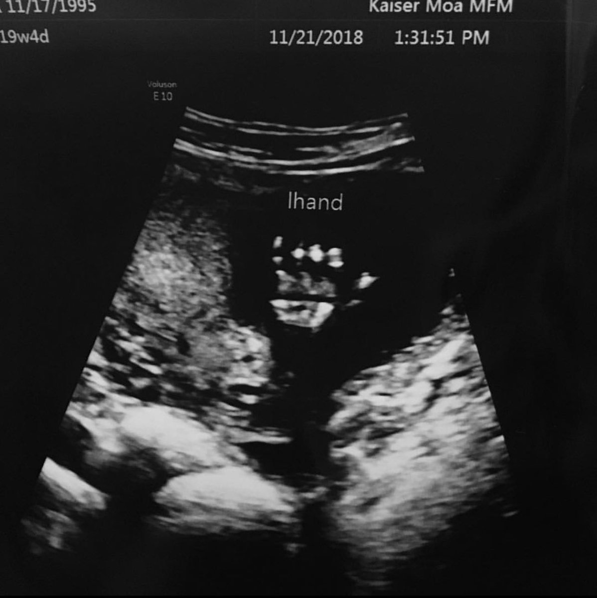 annnierae's tweet photo. Ok but my daughter was throwin da lazy shaka at 19 weeks 🤙🏼 https://t.co/4UUygzcnry