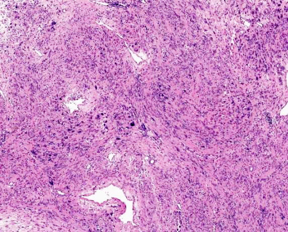 GeronimoJrLapac's tweet photo. Intramyometrial nodule
Diagnosis and a TIP for correct interpretation?

#pathology #gynpath https://t.co/S0dgpslcVT