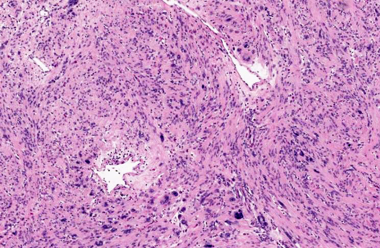 GeronimoJrLapac's tweet photo. Intramyometrial nodule
Diagnosis and a TIP for correct interpretation?

#pathology #gynpath https://t.co/S0dgpslcVT