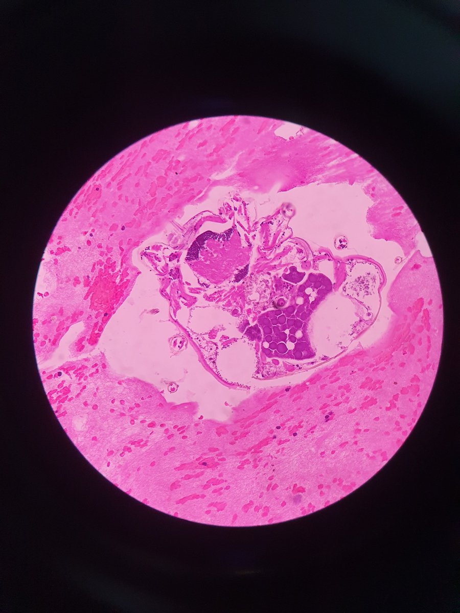 Janoroy24's tweet photo. 35/M left sided pleural effusion.
Cell block pics, your opinion https://t.co/4i0HwKUbG1