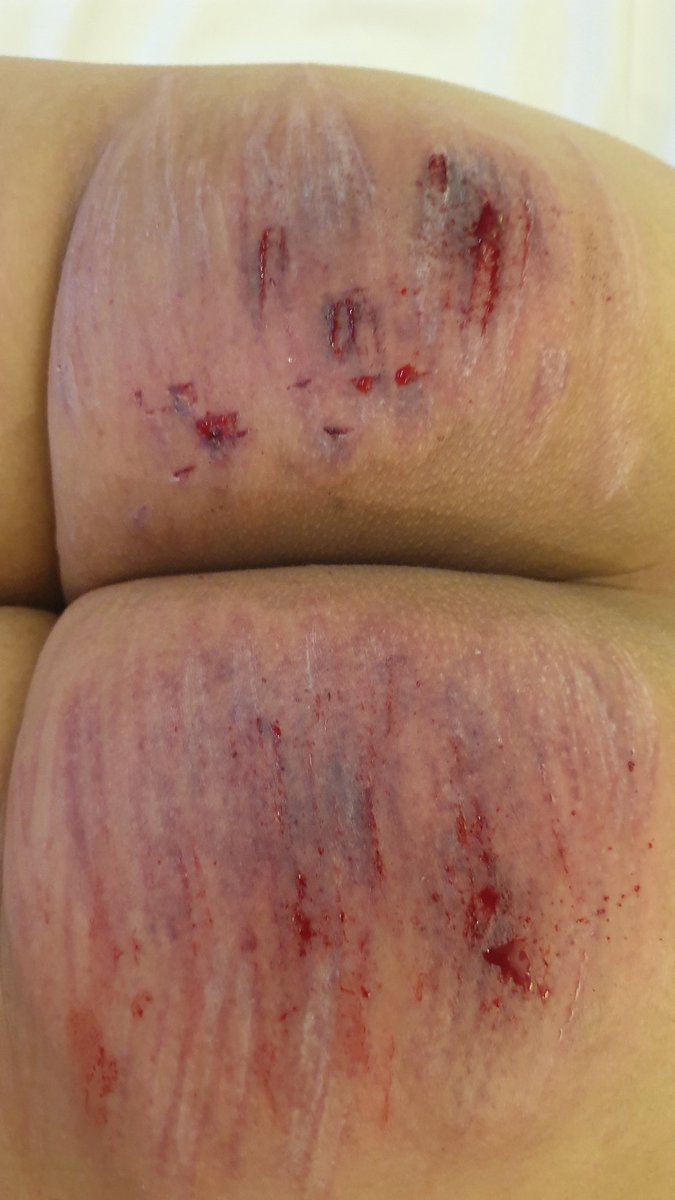 오늘자 어떤 멜키분과 3달만의 두번째 플. 저번에 맞은 매자국들이 아직도 남아있어서 놀랬던;;; 키 받고 방에 들어가려는 순간 바로 옆방에서 배달 음식을 받길래 플하는 내내 신경쓰였었음 ㅋㅋ  #일플 #스팽 #하드스팽 #케인 #멜투멜 #caning #spanking #구인