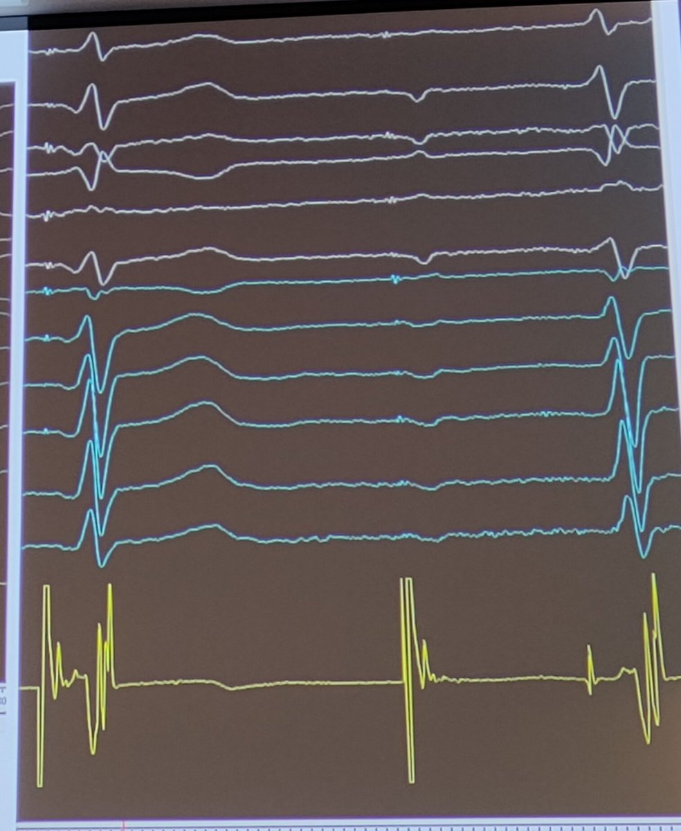 micogriecomd's tweet photo. Keep your 👀 wide open on signals! @messapus is talking about signal interpretation during physiological pacing at Italian national forum on Conduction System Pacing... Something more important than X-Ray, mapping system and contrast... #hisbundlepacing #lbbp #pacing #AIAC https://t.co/nQV1nRwAGp