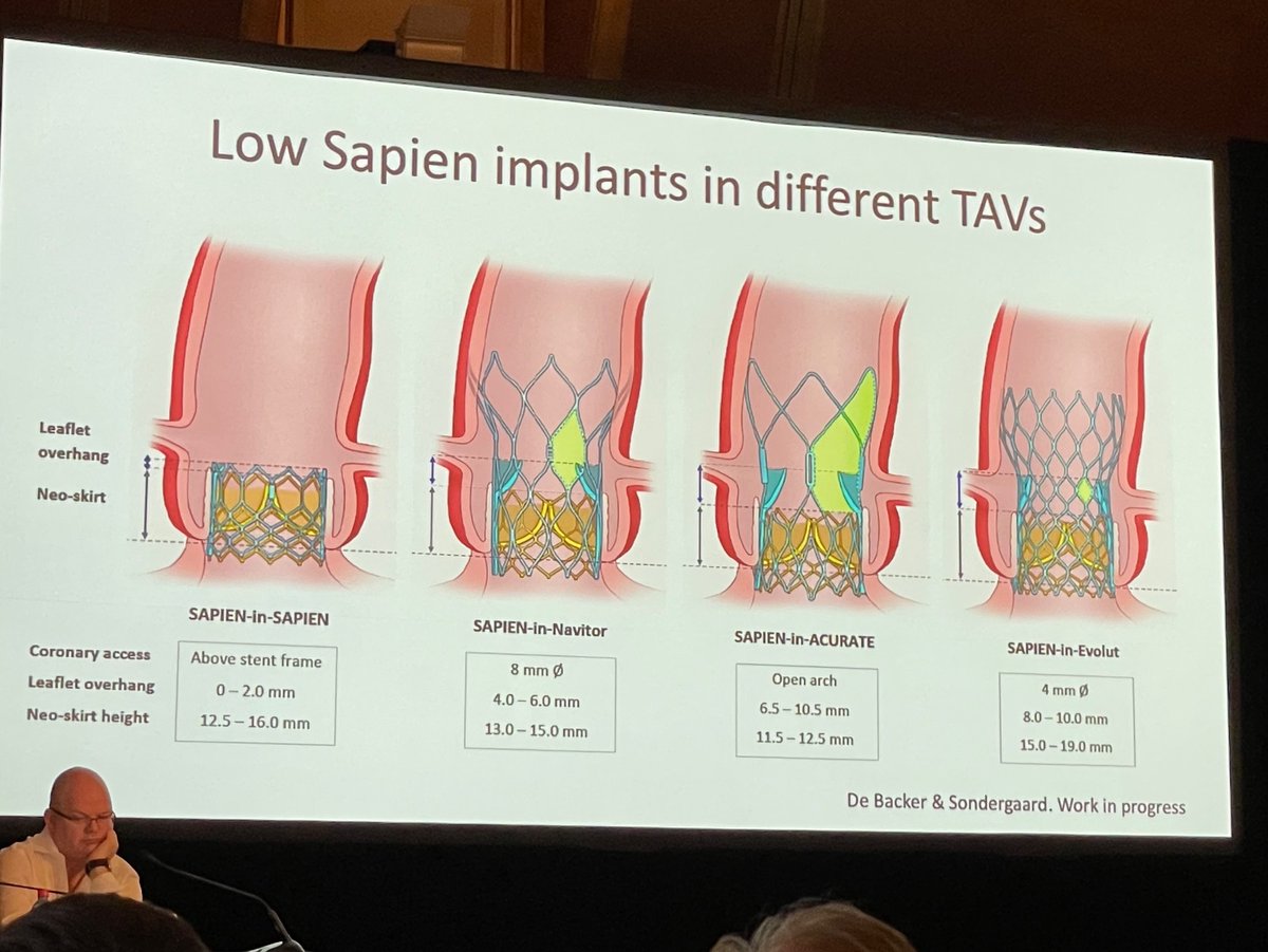Considerations for Sapien-in-TAV cases, including leaflet overhang, neo-skirt height and coronary access, from excellent presentation by Prof Lars Sondegaard @EPIC_meeting Sydney. @_RohanB_ #TAVR