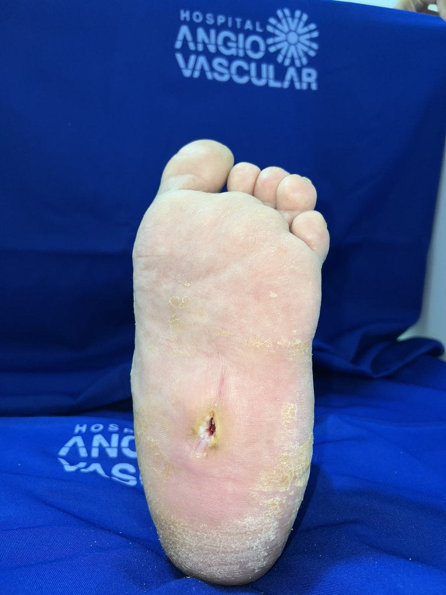 ChaconMatoso's tweet photo. 56 y/o,diabetic evolving with plantar perforating disease, plantar abscess and collapse of bones in the midfoot. Surgical debridement, antibiotics, bone alignment and subsequent plaster cast in total contact. In approximately 2 months wound practically healed.#diabeticfoot https://t.co/eZNkfGjojX