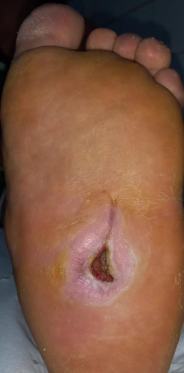 ChaconMatoso's tweet photo. 56 y/o,diabetic evolving with plantar perforating disease, plantar abscess and collapse of bones in the midfoot. Surgical debridement, antibiotics, bone alignment and subsequent plaster cast in total contact. In approximately 2 months wound practically healed.#diabeticfoot https://t.co/eZNkfGjojX