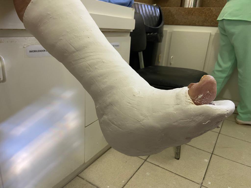 ChaconMatoso's tweet photo. 56 y/o,diabetic evolving with plantar perforating disease, plantar abscess and collapse of bones in the midfoot. Surgical debridement, antibiotics, bone alignment and subsequent plaster cast in total contact. In approximately 2 months wound practically healed.#diabeticfoot https://t.co/eZNkfGjojX