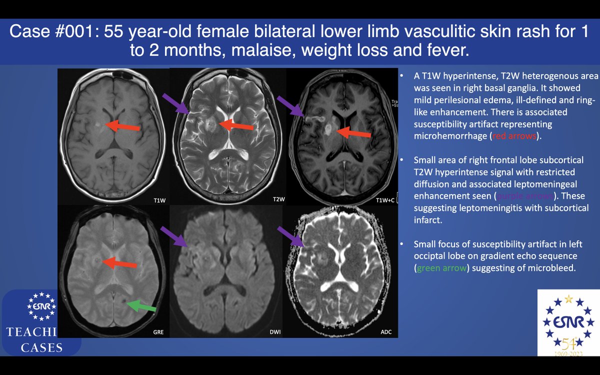 ESNRad's tweet photo. Here is the answer of first #ESNRTC: Thank you Kwok Hoi Ming for sharing this case!

#Neurorad #FOAMRad #radres https://t.co/5mE8gyNAVk