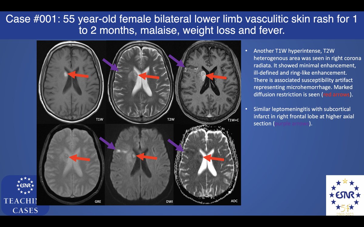 ESNRad's tweet photo. Here is the answer of first #ESNRTC: Thank you Kwok Hoi Ming for sharing this case!

#Neurorad #FOAMRad #radres https://t.co/5mE8gyNAVk