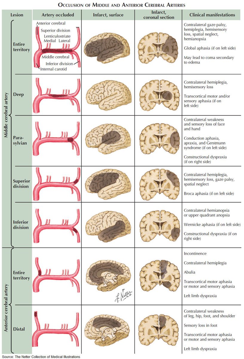 Clinical Manifestations of Middle and Anterior Cerebral Artery Occlusion

#medtwitter #meded #Neurology
h/t <a href="/ManualOMedicine/">Manual Of Medicine</a>