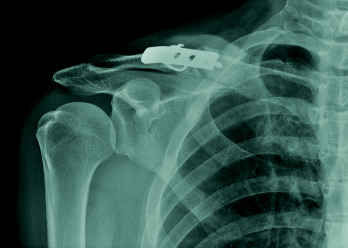 Chances are you or someone you know, has broken their collarbone? #Clavicle fractures are quite common, making up 5% of all adult fractures. Majority of clavicle fractures occur mid-shaft, however, not all clavicle fractures are the same. https://t.co/X9dWyEsn0G #claviclefracture https://t.co/9NnZaqPR1l