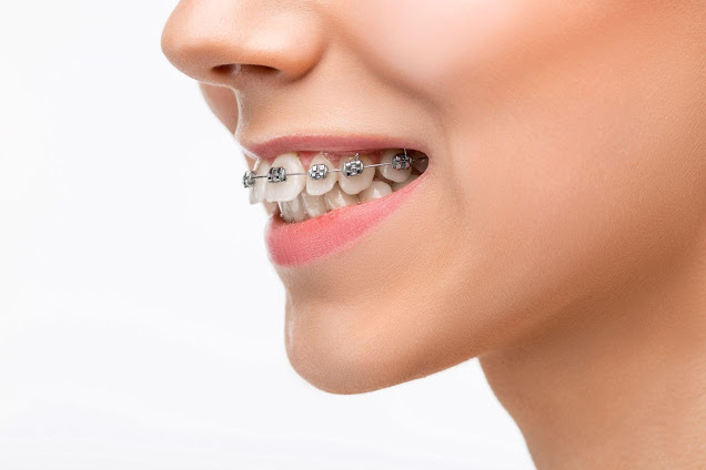 InveigleMagazi1's tweet image. Complications of Overbite &amp;amp; Overbite Treatment for Different Age Groups inveiglemagazine.com/2021/01/compli… #overbite #dentist #trending
