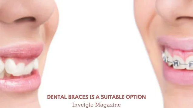 InveigleMagazi1's tweet image. Complications of Overbite &amp;amp; Overbite Treatment for Different Age Groups inveiglemagazine.com/2021/01/compli… #overbite #dentist #trending