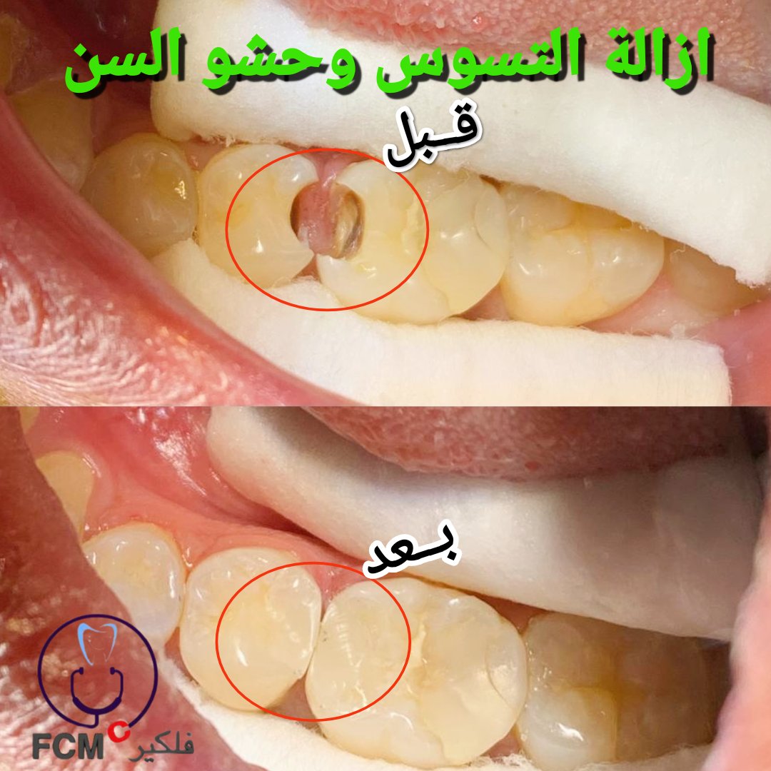 ازالة التسوس وحشو السن.
مركز فلكير لتواصل والاستفسار 
97999370
تابعنا على الانستجرام ..
instagram.com/reel/CoMn2jhsq…

#الهلال_الوداد_المغربي 
#كأس_العالم_للأندية 
#الرسائل_الخاصه 
#الخمائل