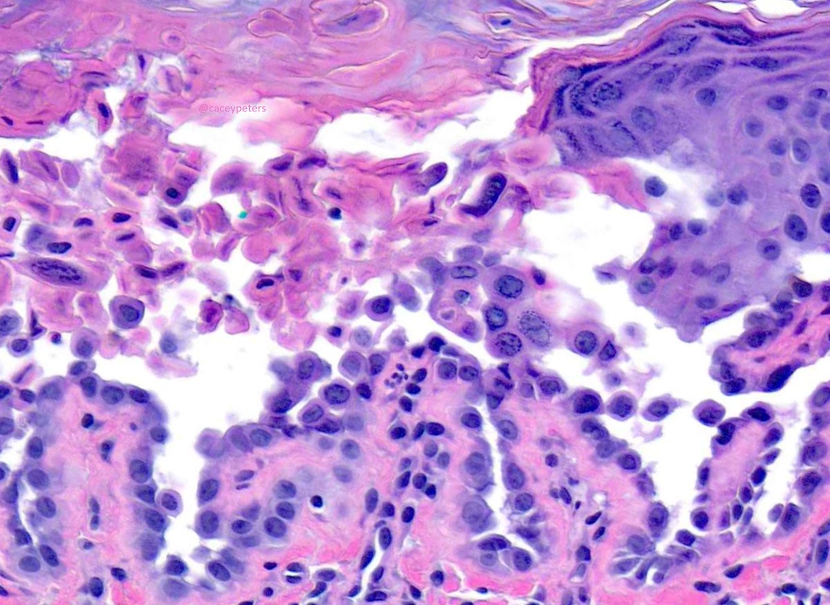 caceypeters's tweet photo. What's your diagnosis for one of these lesions? What about if there are multiple?
#dermpath #dermtwitter #dermatology #dermatologia #pathology #PathTwitter #MedEd #Skin #histology #cutecutis https://t.co/l9LSnxikCI
