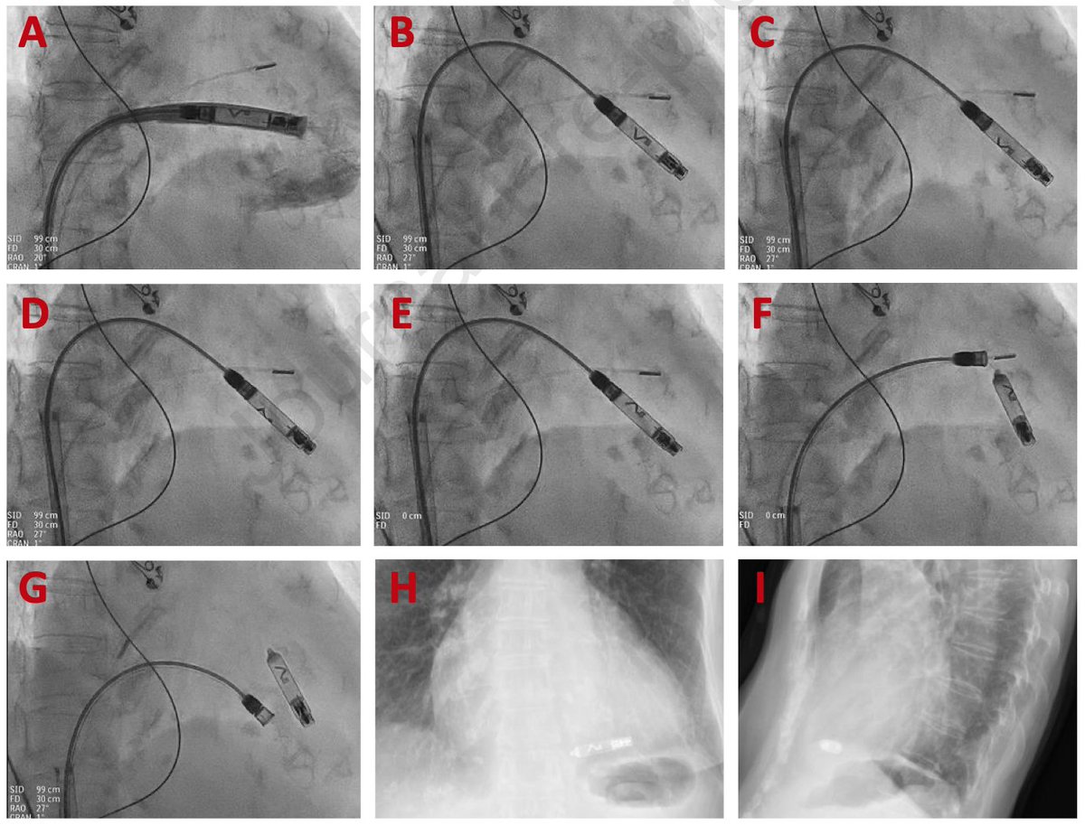 Heart Rhythm Case Reports tweet media