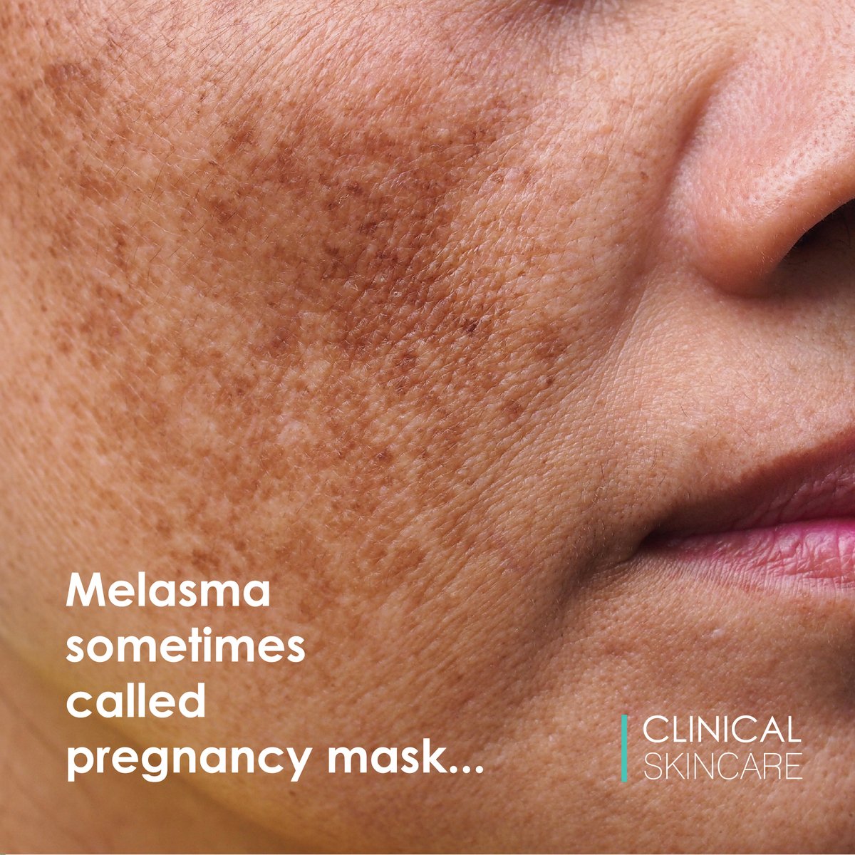 Melasna can be caused by sun exposure, hormonal treatments (contraceptive pills), certain medications, pregnancy and hypothyroidism (under active thyroid gland)
Book a free consultation to see how we can help you. 
clinicalskincare.co.uk
#melasma #melasmatreatment #skincare