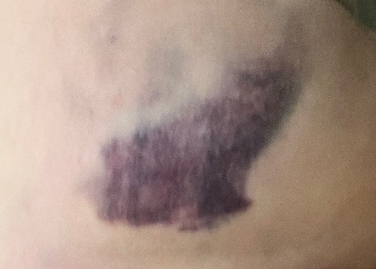 BeIndelible's tweet image. My #clumsy ass. Literally. Slipped on the stairs.