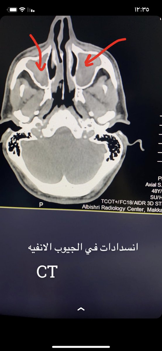 diagnostic_exp1's tweet image. حالات الإنسداد في الجيوب الأنفيه 
أشعة مقطعية على الجيوب الأنفيه #ct_scan #radiology #مركز_أشعة @BRC_radiology