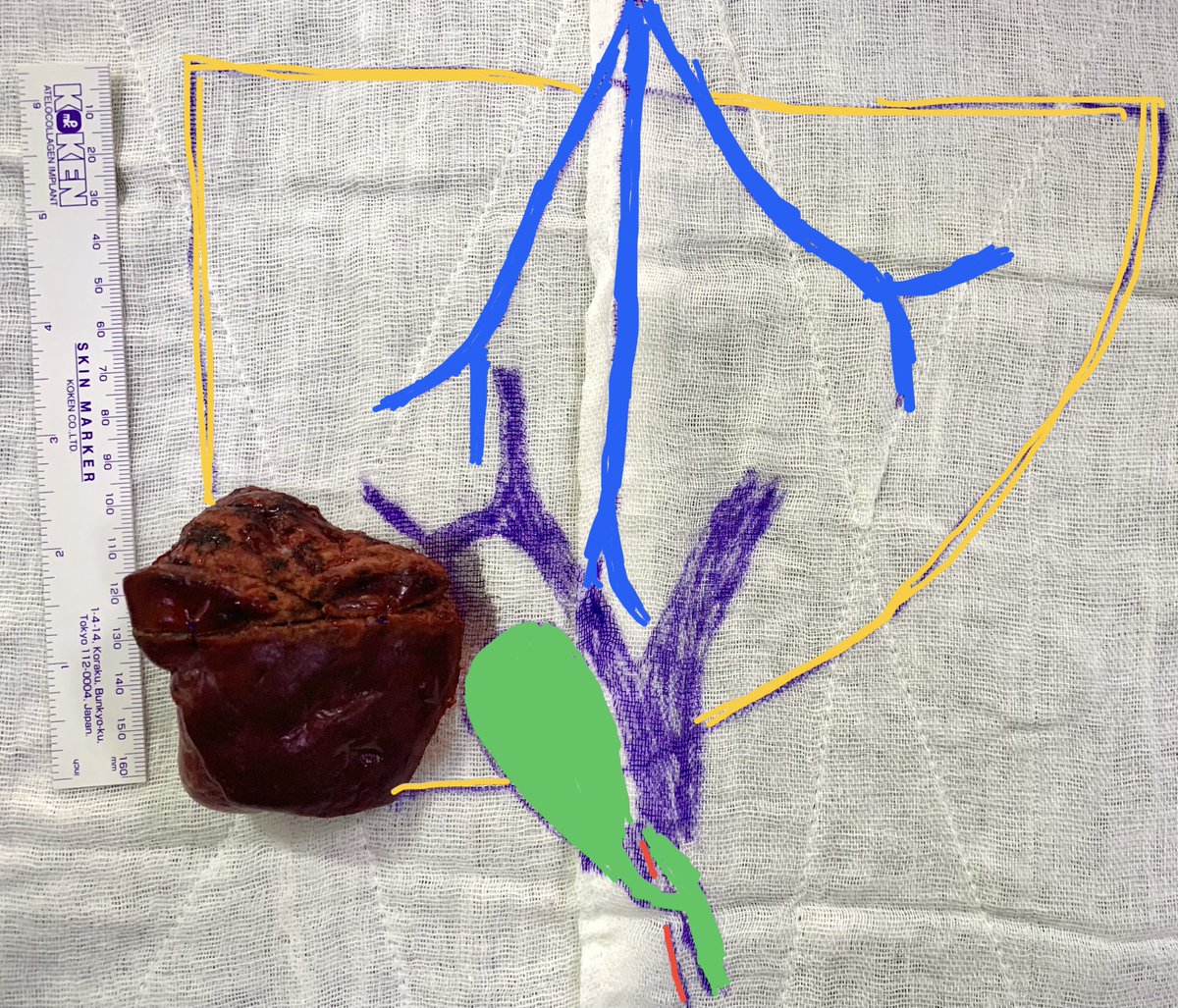 Hassaan Bari (@dr_hassaanbari) on Twitter photo About last 2 cases;
Nearly same📍of Tx
Same🔪
1-Cholangio in 52 👦, with liver cirrhosis
2-Hepatoblastoma in 18 months 👶
Hepatoblastoma-🚫complications, home D4
Cholangio-grade A PHLF 🧐😕
<a href="/IHPBA/">IHPBA</a> <a href="/HpbLounge/">HPB Lounge</a> <a href="/hpb_so/">SoMe4HPB</a> <a href="/SOS_Pk/">Surgical Oncology Society Pakistan. SOSPK</a>
#liver #MedEd #cancerday2023 #cancer #hpb #surgery About last 2 cases;
Nearly same📍of Tx
Same🔪
1-Cholangio in 52 👦, with liver cirrhosis
2-Hepatoblastoma in 18 months 👶
Hepatoblastoma-🚫complications, home D4
Cholangio-grade A PHLF 🧐😕
<a href="/IHPBA/">IHPBA</a> <a href="/HpbLounge/">HPB Lounge</a> <a href="/hpb_so/">SoMe4HPB</a> <a href="/SOS_Pk/">Surgical Oncology Society Pakistan. SOSPK</a>
#liver #MedEd #cancerday2023 #cancer #hpb #surgery