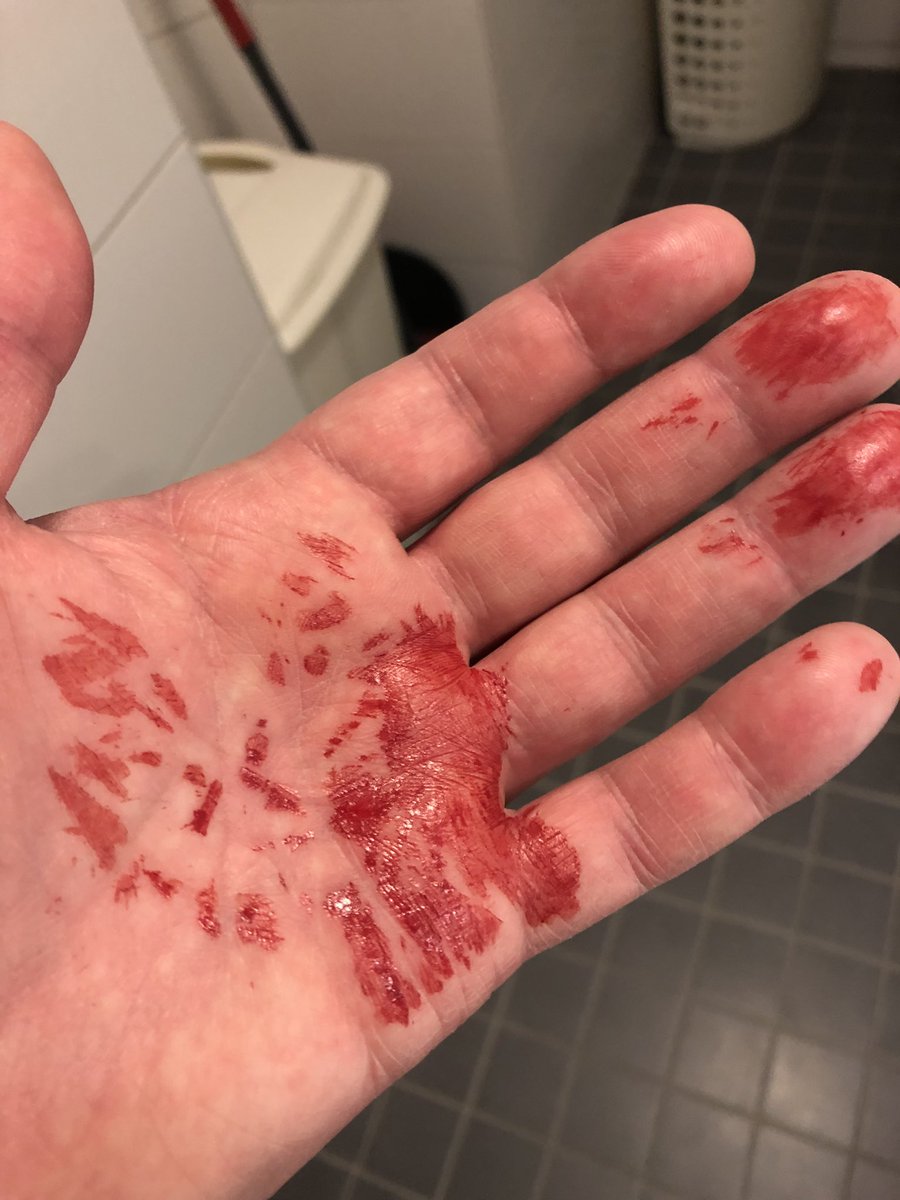 MangePange787's tweet photo. Egna noteringar:
Badrumsskåp är elaka.
Res inte på huvudet onödigt fort.
#dumt
#dummare
#jättedummast 🤕 https://t.co/8q2wc3XxXc