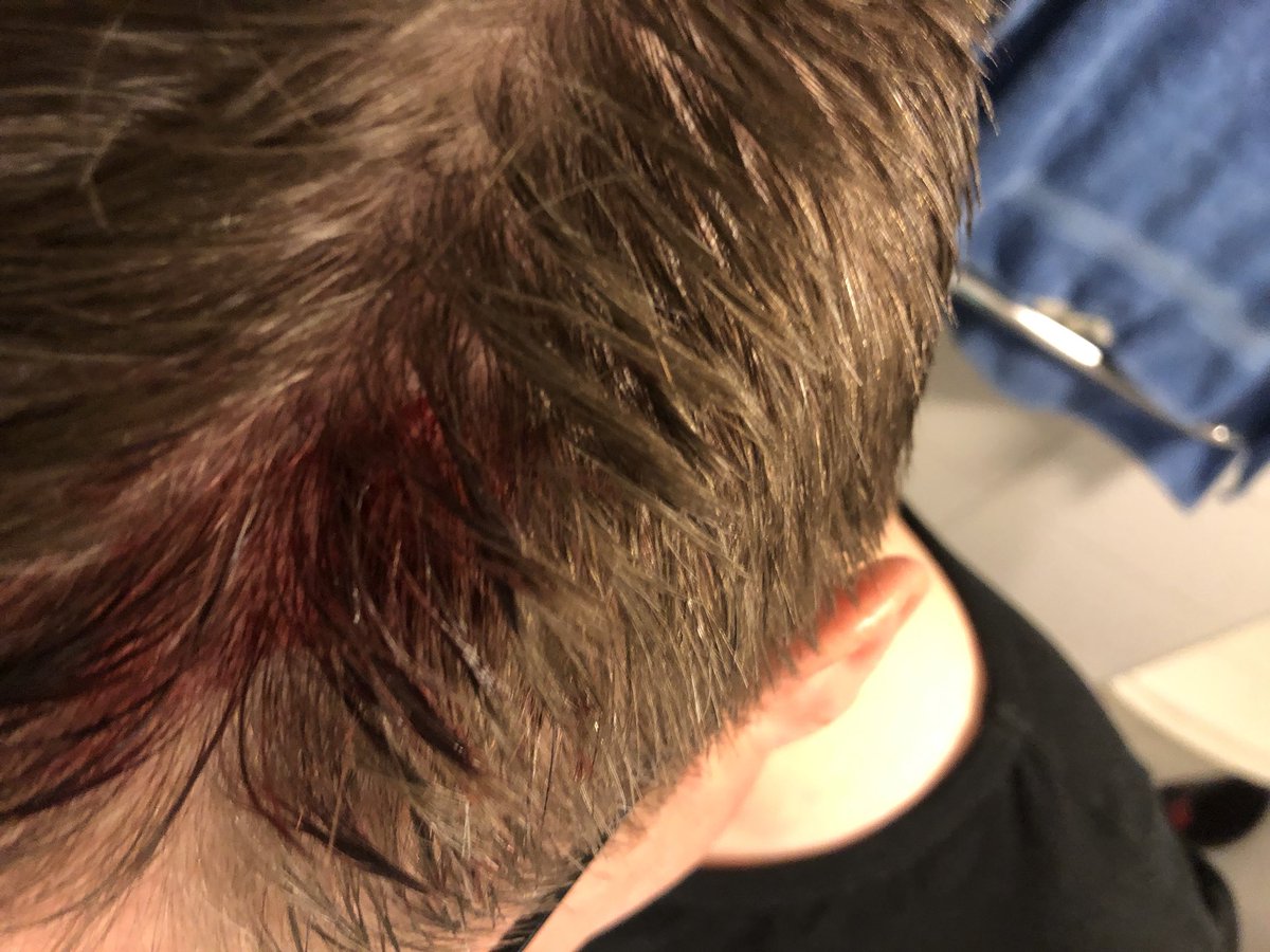 MangePange787's tweet photo. Egna noteringar:
Badrumsskåp är elaka.
Res inte på huvudet onödigt fort.
#dumt
#dummare
#jättedummast 🤕 https://t.co/8q2wc3XxXc