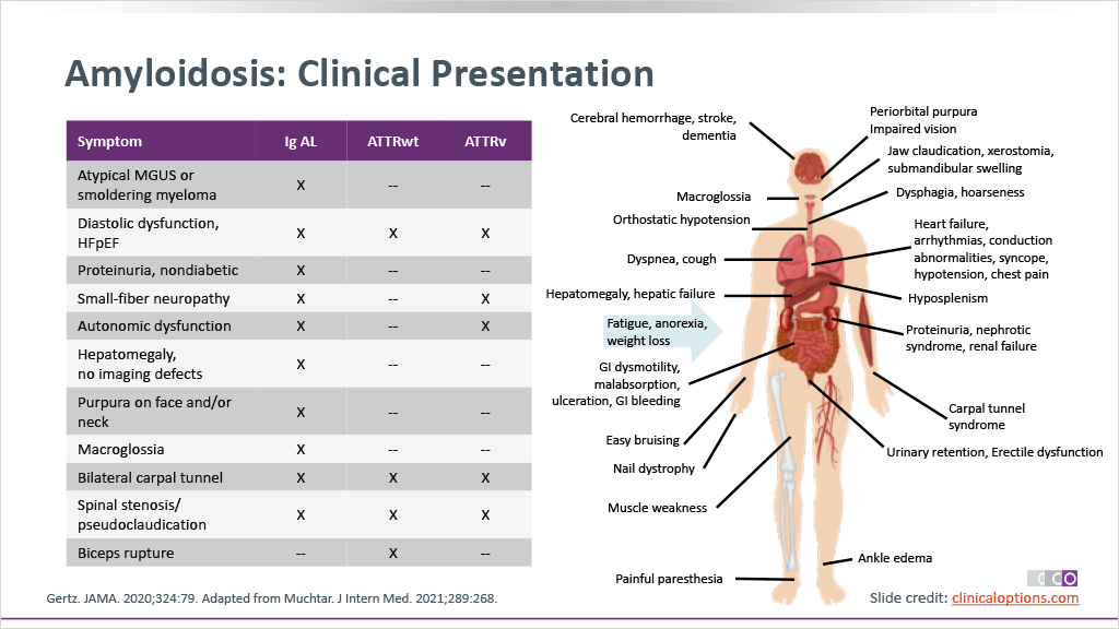 aVoice4ALS's tweet photo. 30 types of #amyloidosis
What type did #Musharraf have?
What organs affected?

AL amyloidosis is most common, but #ALECT2 is common among Latinos, Egyptians &amp; Punjabi communities.  Other common types = ATTR, AA.

Important opportunity to raise awareness.

https://t.co/xScEqxAmpO https://t.co/9LZU03jplH