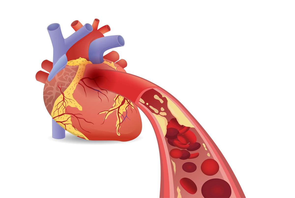 Roughly 1️⃣in2️⃣pts received #GDMT before #CTO #PCI. These findings suggest an opportunity to⬇️ variability in management before CTO PCI bit.ly/3jxYhVr #GDMTworks #CVD #CAD @mmamas1973 @DrMarthaGulati @DocSavageTJU @mirvatalasnag @DLBHATTMD @HeartOTXHeartMD @fischman_david