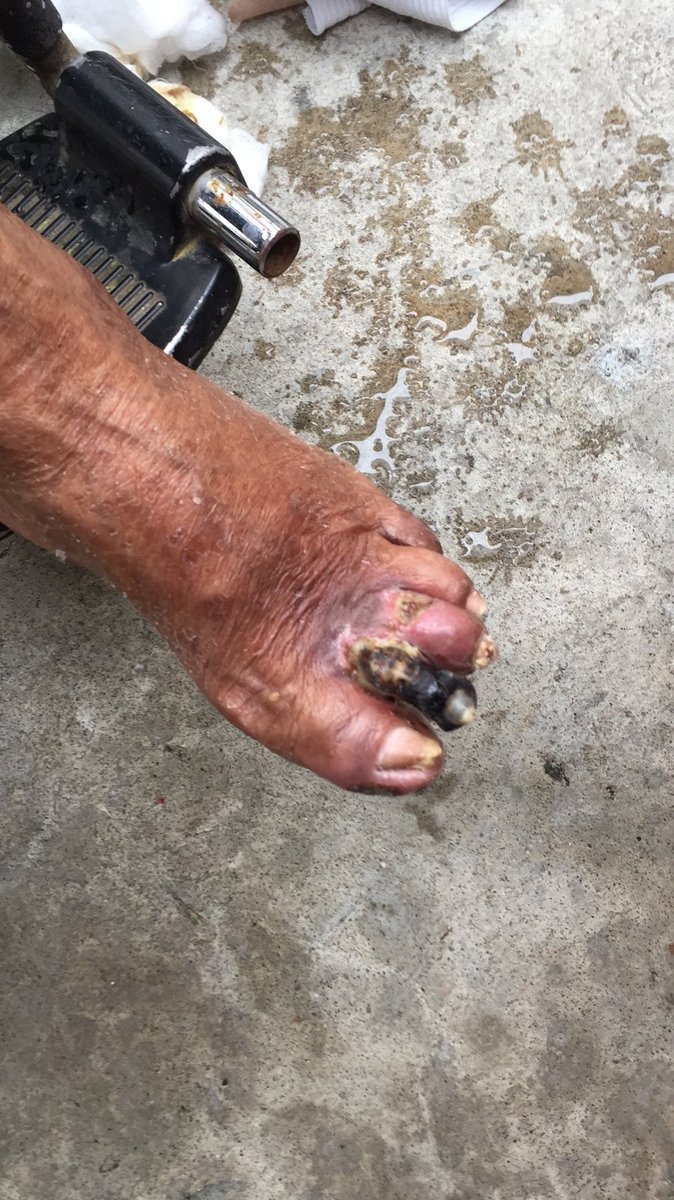 Paciente de 78 años con DM con complicaciones microvasculares, pie diabetico, 15 dias hospitalizada esperando un procedimiento . Es esto justo con la gente señores de la EPS COOSALUD? <a href="/Supersalud/">Supersalud</a>