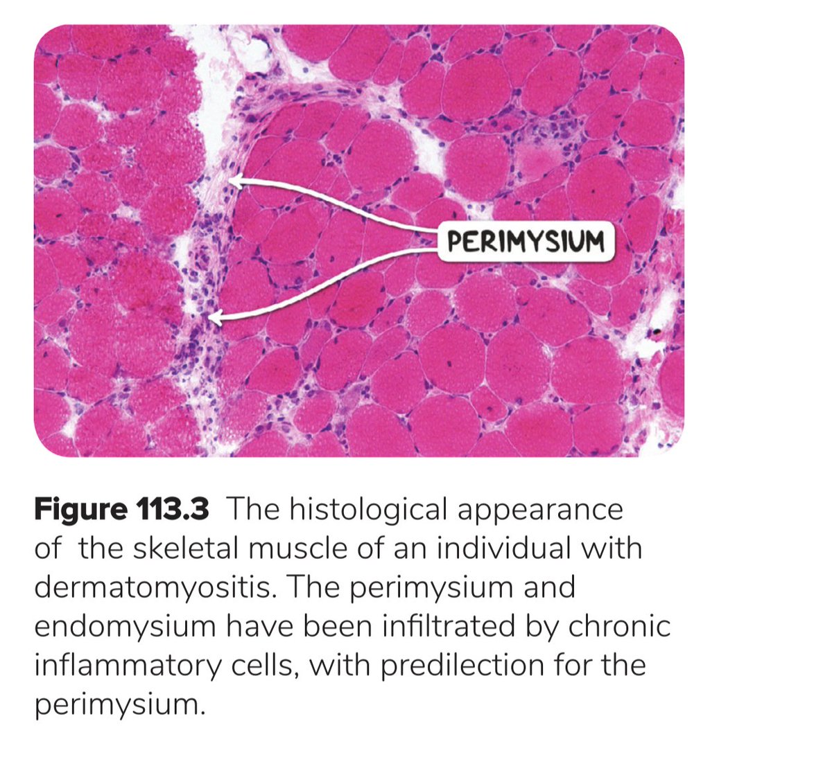 dr_pablomonroy's tweet photo. #Reumatips #ENARM2023: Dermatomiositis
- Relación H/M: 1/2
- Localización: Proximal simétrica
- Lesiones cutáneas: Sí (Patognomónico) - Rash heliotropo
- Niveles CPK: Aumentados
- Ac: Anti-Mi 2
- Biopsia: Infiltrado perimisial y perivascular de LT CD4 y B
- Tx: Esteroides https://t.co/9fKWwBHK4R