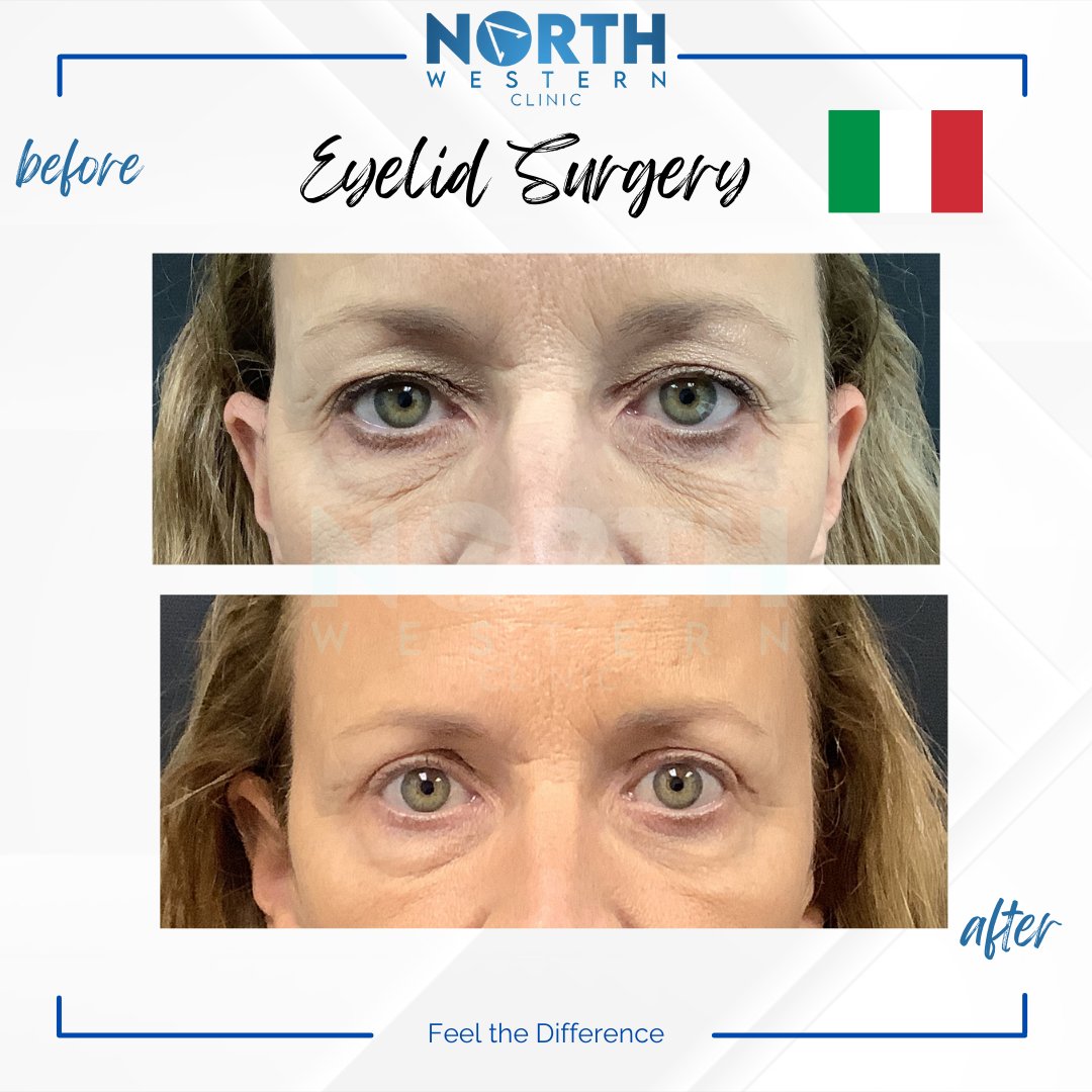 NorthWesternTR's tweet photo. 🇮🇹 Say goodbye to tired eyes and hello to a refreshed, youthful look with eyelid surgery at North Western Clinic. The difference is stunning. #beforeandafter #eyelidsurgery #beauty" https://t.co/nNwS57Hv67