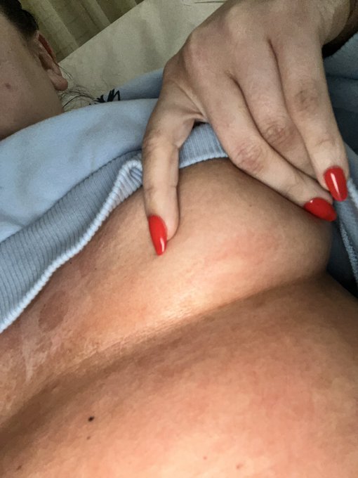 2 pic. Found out I have an abscess and then when the er gave me iv antibiotics I swelled up in 3 minutes