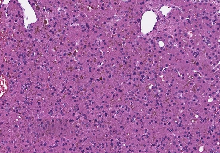 megothelioma's tweet photo. Parathyroid histology (hypercellular parathyroid, in this case):
โก๏ธchief cells - smaller, comprise the majority of the cellularity
โก๏ธoxyphil cells - eosinophilic cytoplasm (lots of mitochondria)
โก๏ธusually ~50% fat, with more adipose as we age
#BasicPath #PathTwitter https://t.co/UJh2vcZwML