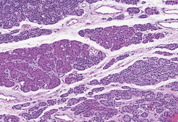 megothelioma's tweet photo. Parathyroid histology (hypercellular parathyroid, in this case):
โก๏ธchief cells - smaller, comprise the majority of the cellularity
โก๏ธoxyphil cells - eosinophilic cytoplasm (lots of mitochondria)
โก๏ธusually ~50% fat, with more adipose as we age
#BasicPath #PathTwitter https://t.co/UJh2vcZwML