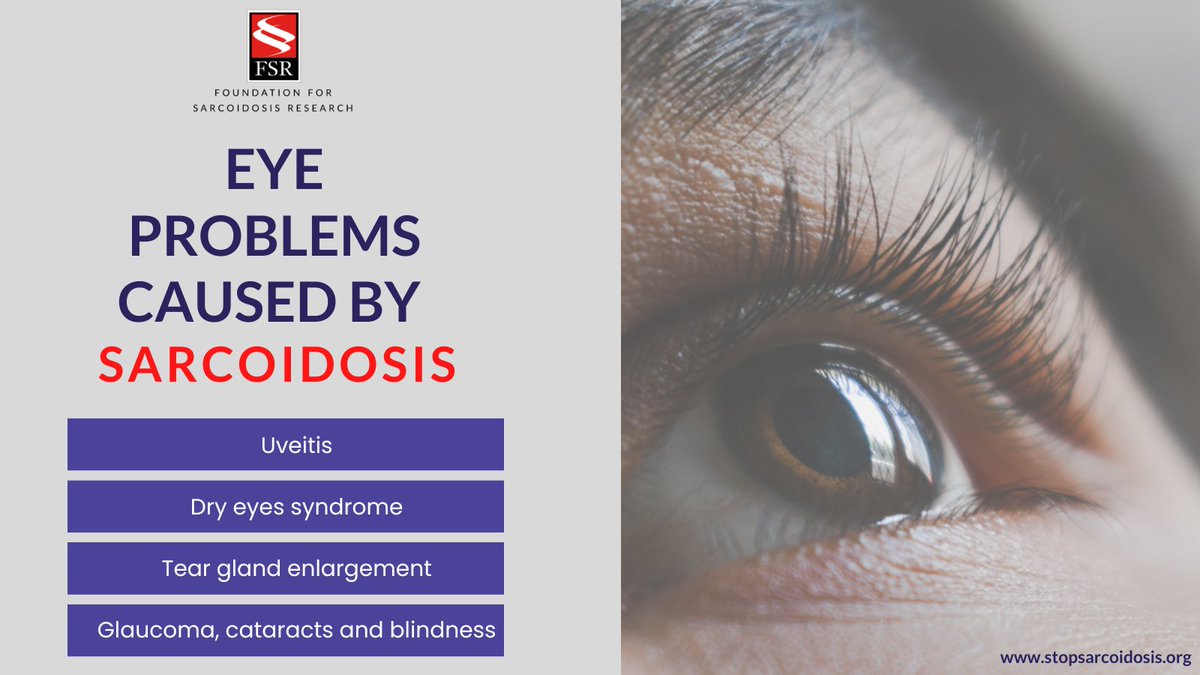 StopSarcoidosis's tweet photo. Sarcoidosis affects the eyes in a quarter or more of people with the disease. Learn more at https://t.co/99xCWd6K4A
#sarctwitter #sarfact https://t.co/940UT0duEn