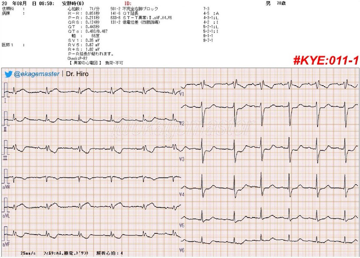Dr on twitter 72 yo male ht dl p w left precordial