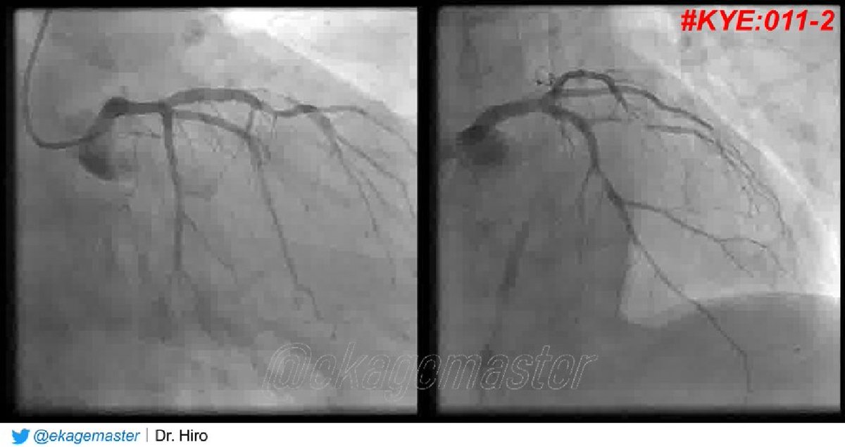 Dr on twitter 72 yo male ht dl p w left precordial