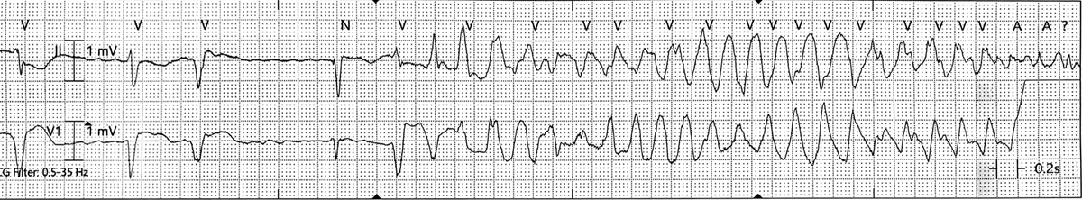 CardiacSchool's tweet photo. ECG of the week! @bringWenckebach @DevezaRicardo @cardiotommy @kearney_kate https://t.co/jxCH6jBE1s