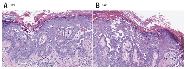 #DarierDisease (DD) is a rare, autosomal dominant disorder with an approximated prevalence of one to two cases per 100,000 people. Here, authors present a rare case of linear DD: bit.ly/3HACBA3 #dermtwitter