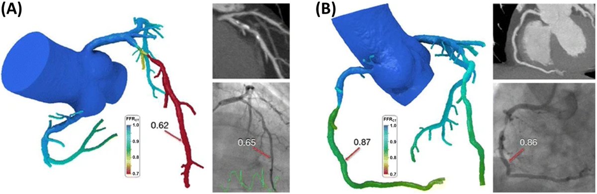 #RCM-Special Issue: Coronary Artery Atherosclerosis: Translation from Basic to Clinic (5/5)

🎉Current and Future Applications of Computational Fluid Dynamics in Coronary Artery Disease

#Hemodynamics #CFD #CAD #atherosclerosis #computer 

Full Text:
imrpress.com/journal/RCM/23…