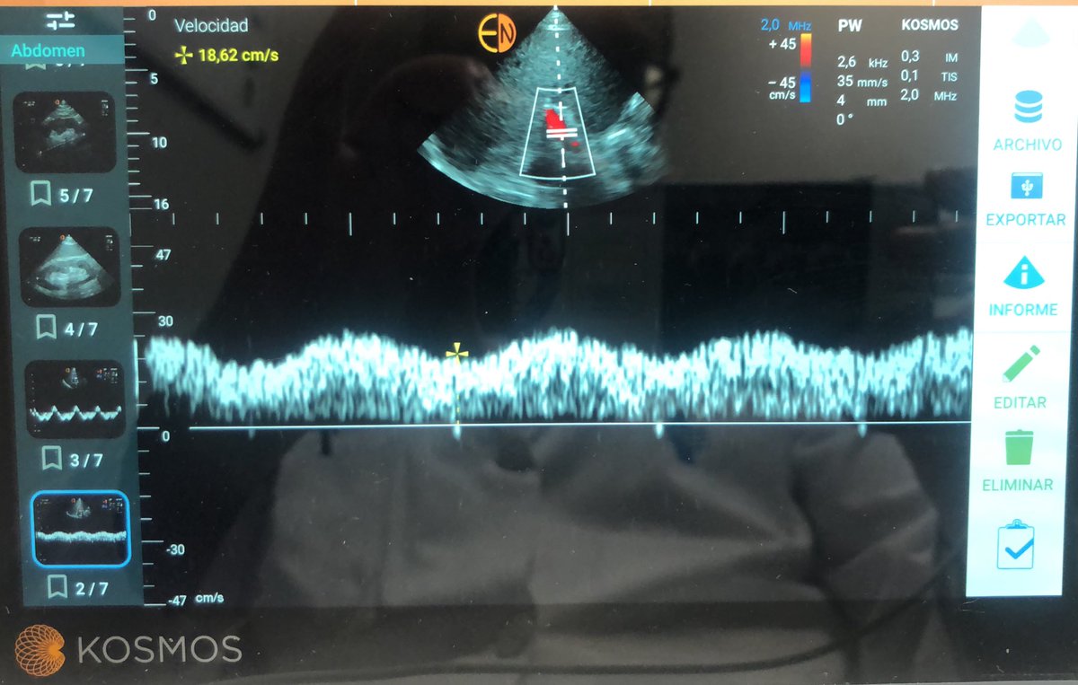 Tubulocentric's tweet photo. Back to basics but now with #PoCUS #congestionnomore #avoidcongestion @hgermanstrias @bover_j @JordiSolerM @JJuega @Errantnephron @NephroNess @nefrointerpocus @mvaca87 @mardomingo10 @POCUS_Duilio https://t.co/ihJBlBFWAN