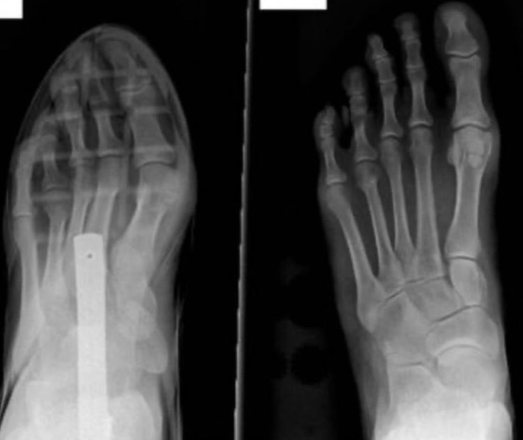 Jason on Twitter "Are regular shoes bad for your knees? I think so