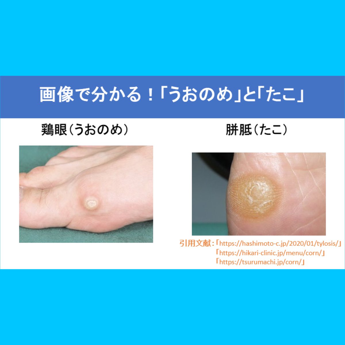 2v2EM330uz4xU9X's tweet photo. 看護師国家試験の新出題基準！

今回は『うおのめ』と『たこ』です。

分かりやすくイメージできるように画像もあるので参考にして下さい。

イボとの違いも押さえておきましょう！ https://t.co/wvC1C47z53