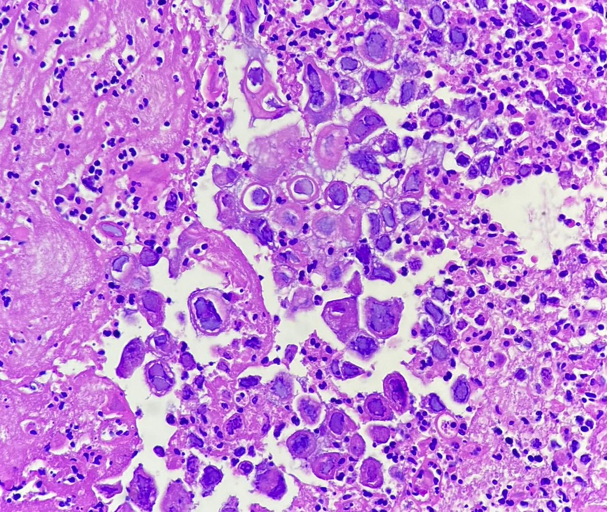 gauriii_23's tweet image. Oesophagus ulcer 38/M