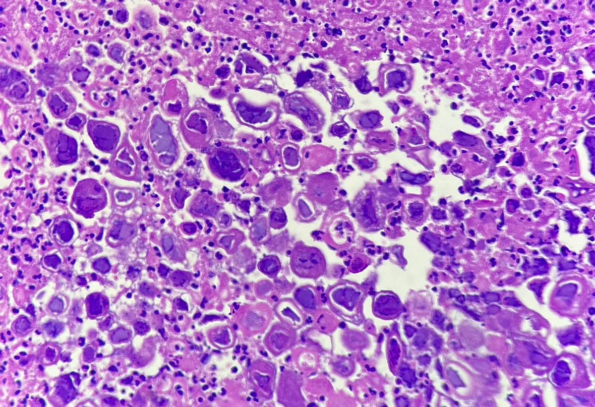 gauriii_23's tweet image. Oesophagus ulcer 38/M