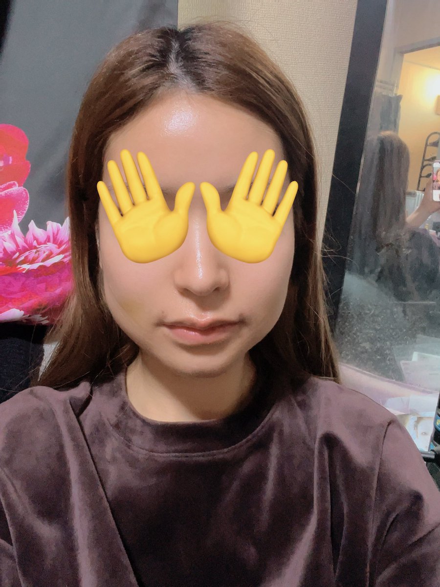 yurichi_638's tweet photo. DT11日目
左側がまだ結構腫れてて凄い硬くなってる😢
でも知らない人から見たらバレないレベルかな😇

ぶっちゃけタバコはDT1日目から吸ってるし、1日中家でぐーたらしてるし、頭を心臓より高くして寝た方がいいみたいの聞いてたけど全くやってないw

#ビュー美容外科 https://t.co/FvwVZCHV9E