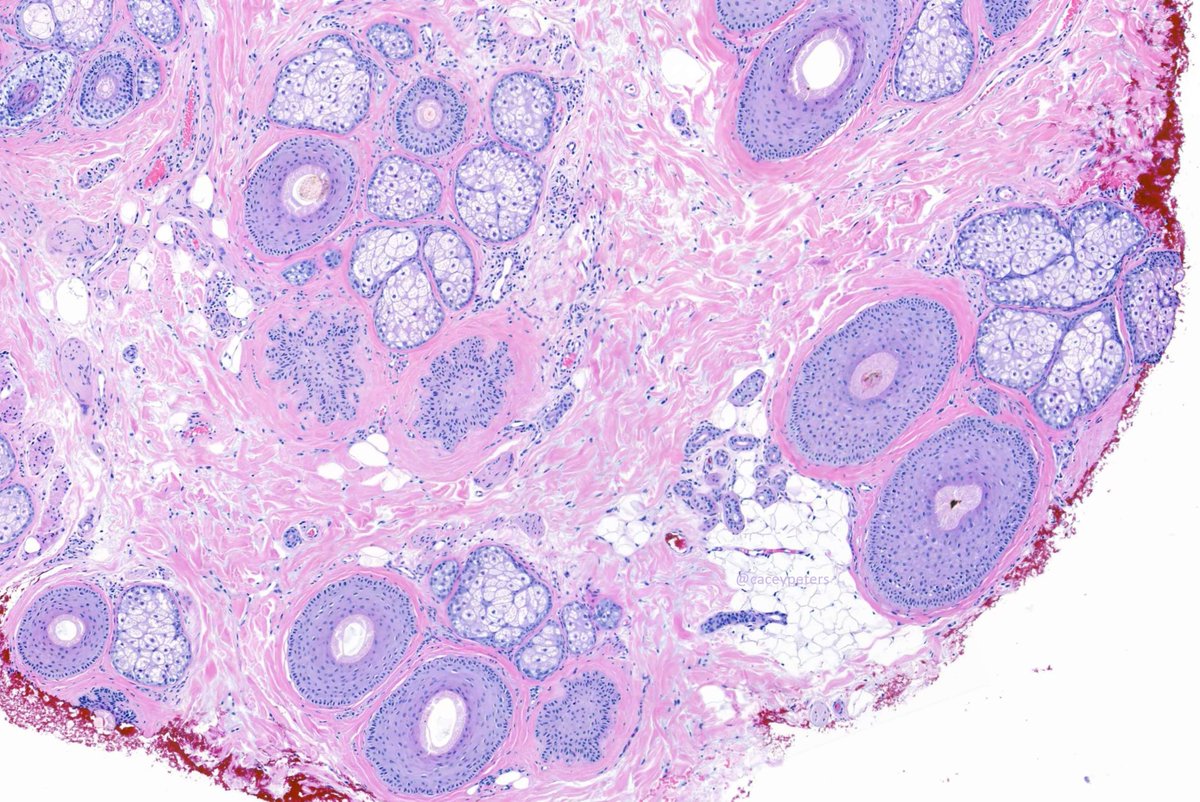 Great example of this entity. Why might this patient be losing their hair?

#hair #dermpath #dermatology #dermtwitter #pathology #PathTwitter #MedTwitter #MedEd