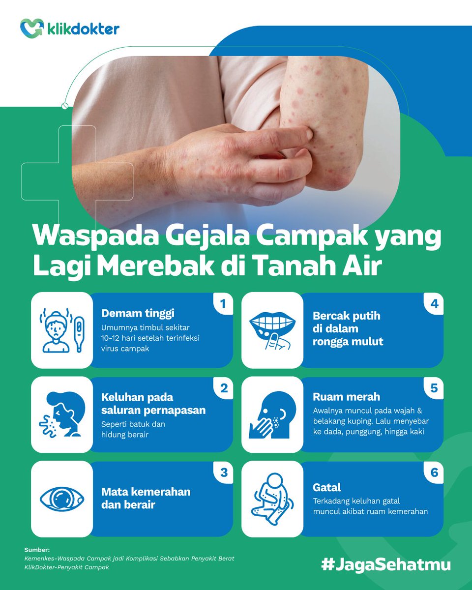 klikdokter_id's tweet image. Iyes, gejala campak itu salah satunya muncul ruam merah di tubuh 🔴🔴🔴

Selain itu, apa aja gejala-gejala lainnya? 

Yuk kenali biar bisa langsung ditangani! 👇

#JagaSehatmu #Kulit #Campak
