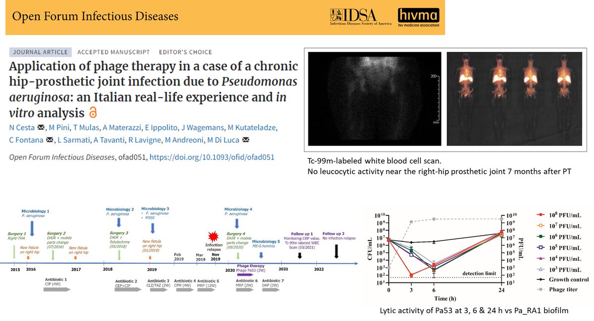 Chronic Prosthetic joint #infection by #Pseudomonas aeruginosa successfully treated after personalized #phage &amp; meropenem combination #therapy .
Case study in Italy coordinated by <a href="/GraceDiluca/">Mariagrazia Di Luca</a> , #publication in <a href="/OFIDJournal/">Open Forum Infectious Diseases</a> :
bit.ly/3X5f3Jh

#biofilm #microbiology #AMR